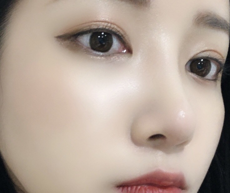 눈밑지방재배치 + 코수술까지 95일!