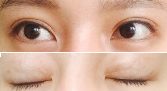 비절개눈매교정(재수술), 뒤트임 대만족스러워요!! 굿굿