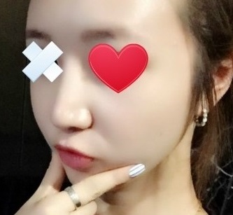 코수술, 지방이식 7개월 넘었어요~