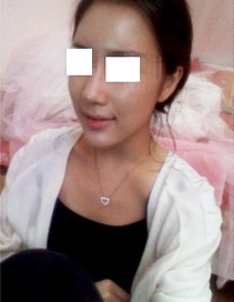 미스코 지방이식 2주째와 3주째 과정이예요~~~~~