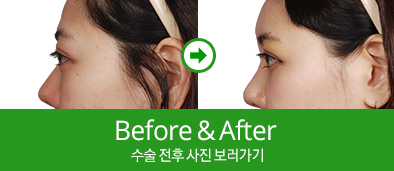 전후사진