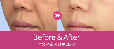 전후사진